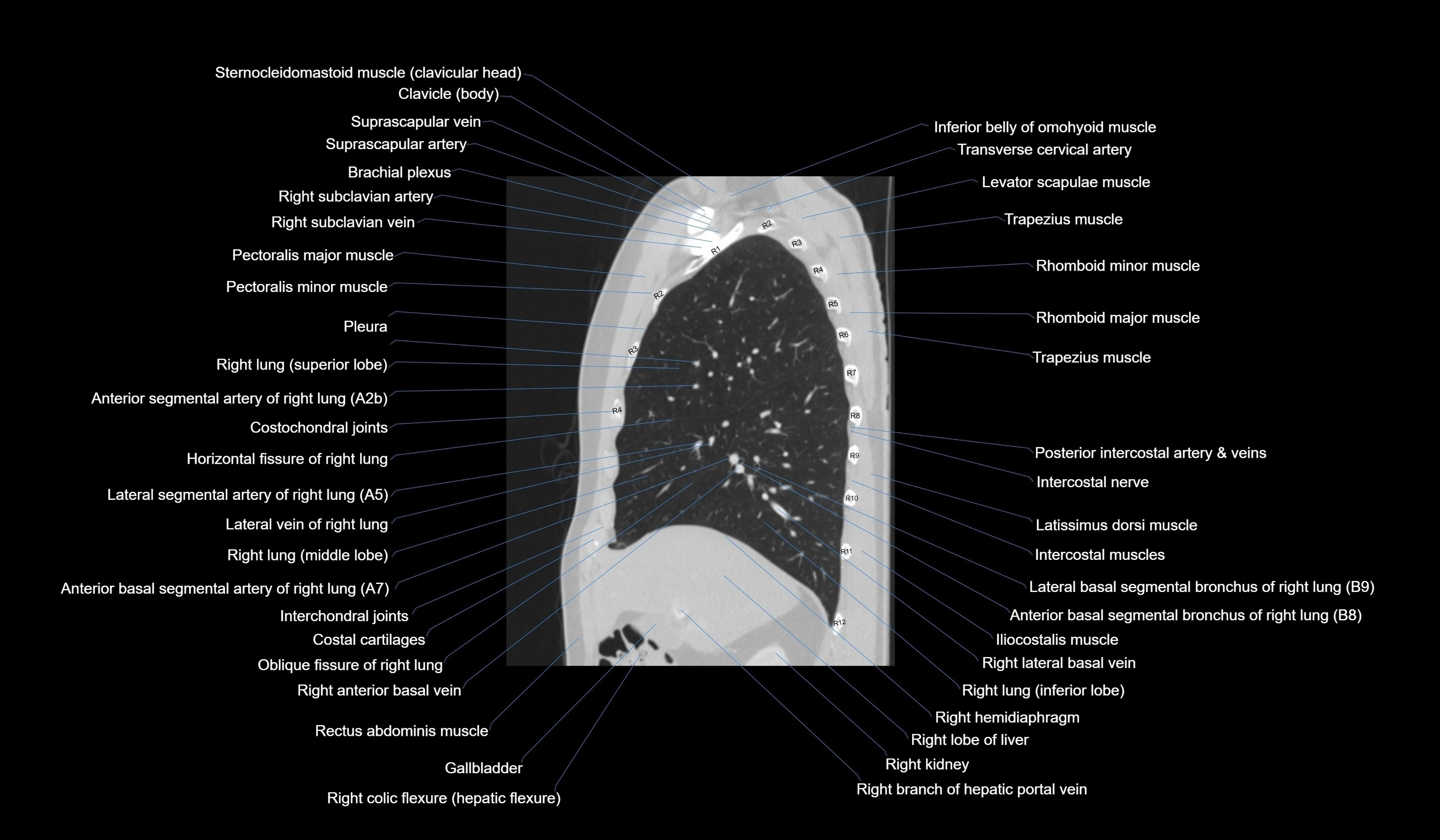 CT chest (thorax) lung window labelled sagittal cross sectional anatomy radiology image-00048.webp